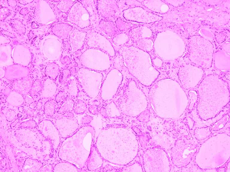 thyroid