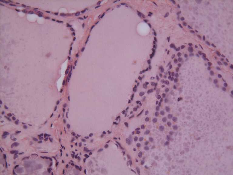 thyroid
