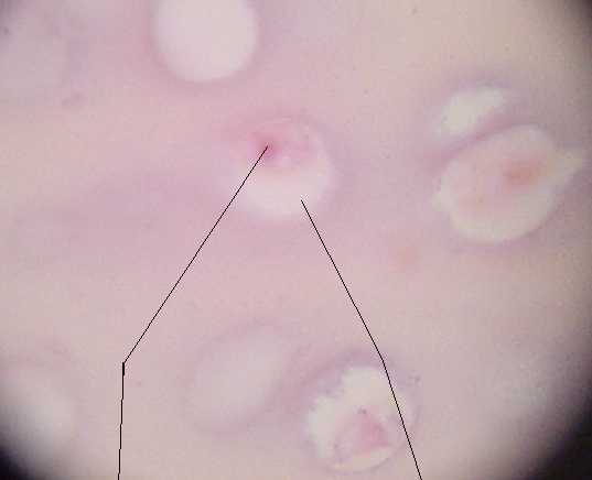hyaline