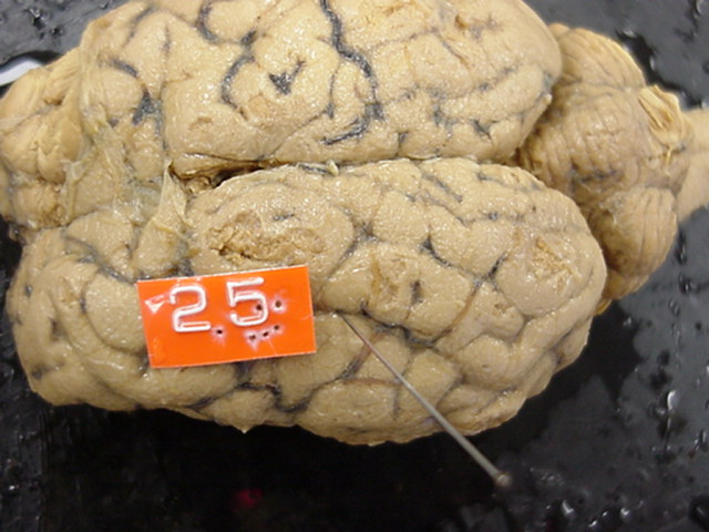 sulcus
