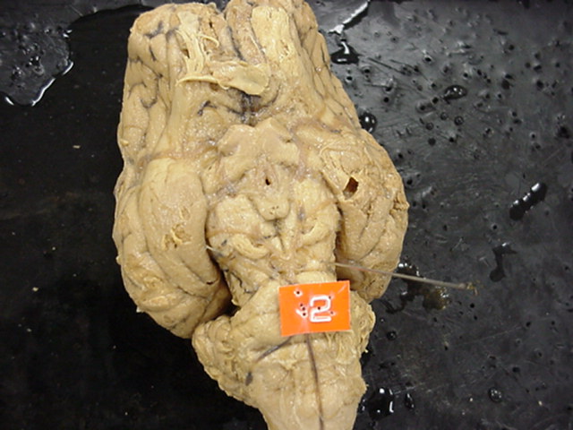 cerebral peduncles