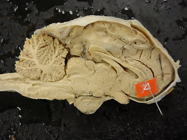 corpus callosum
