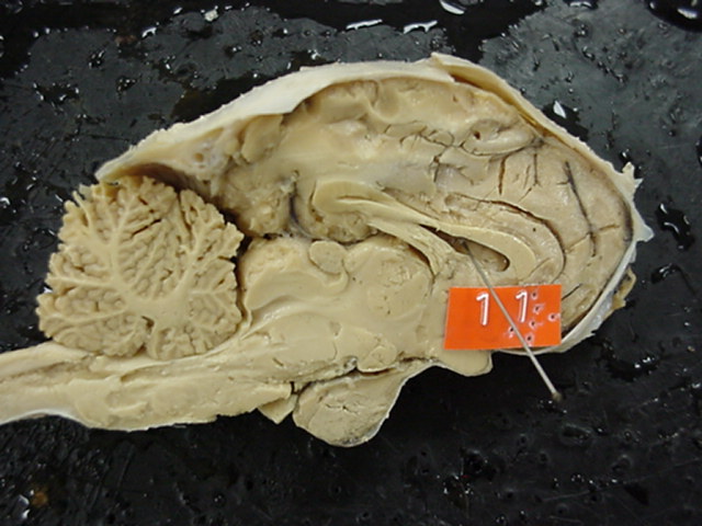 lateral ventrical