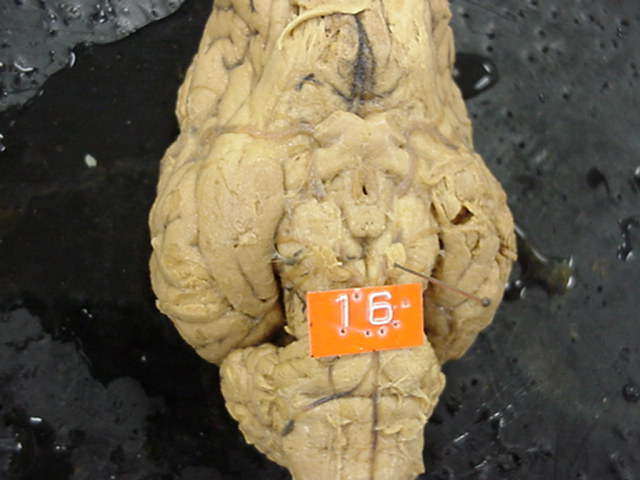 occulomotor nerve