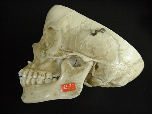 mandible