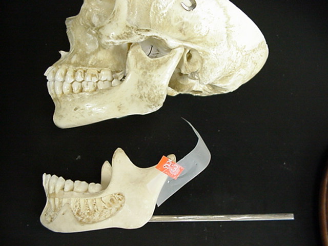 mandibular process (condyle)