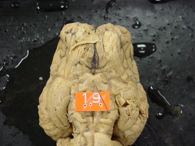 optic chiasma