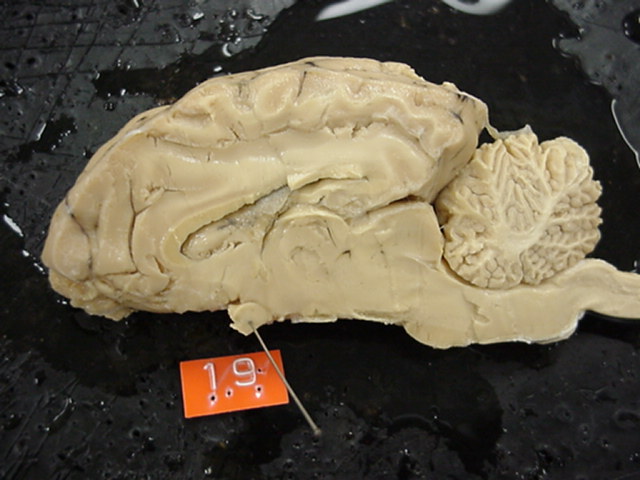 optic chiasma