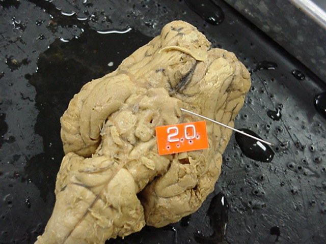 optic nerve