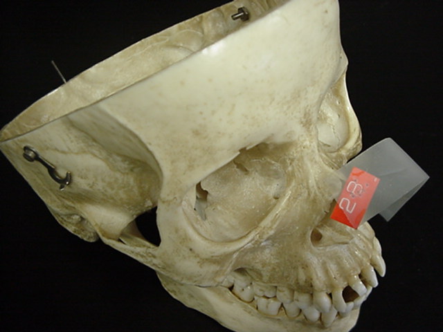 nasal