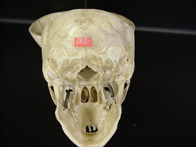 occipital bone