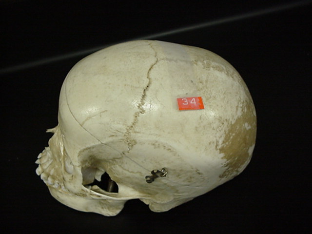 parietal bone