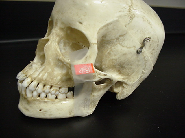 zygomatic bone